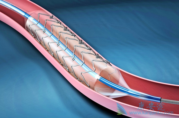心脏支架手术 心脏支架手术