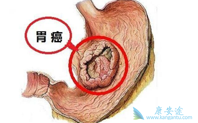 胃癌的治疗 胃癌的治疗