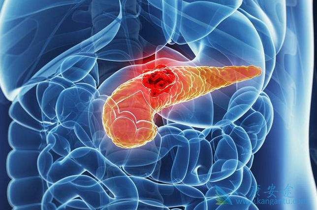 胰腺癌的症状 胰腺癌的症状