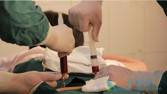 骨髓移植 骨髓移植