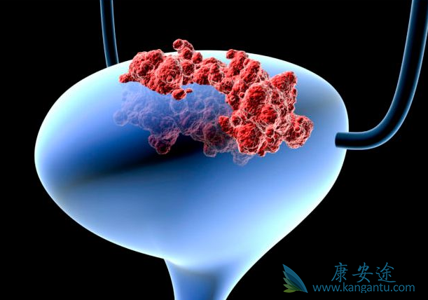 膀胱癌晚期症状 膀胱癌晚期症状