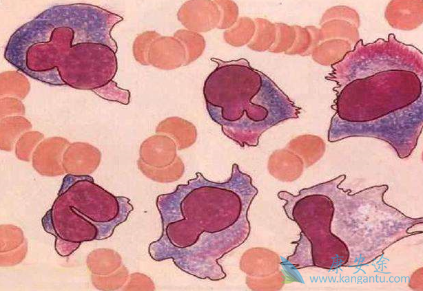 多发性骨髓瘤症状 多发性骨髓瘤症状