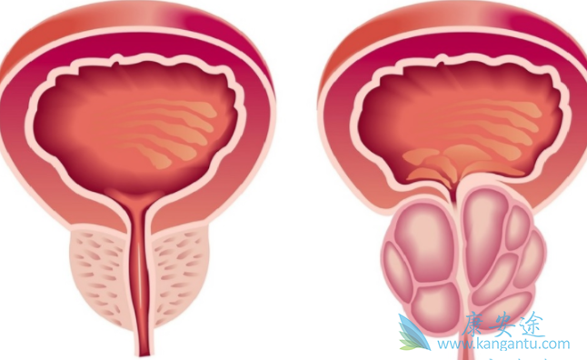 前列腺癌治疗 前列腺癌治疗