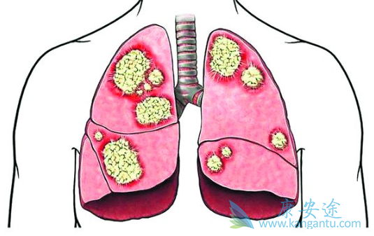 肺癌的症状 肺癌的症状