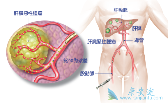 经动脉放射栓塞 经动脉放射栓塞