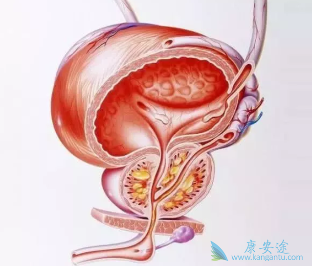 前列腺癌晚期 前列腺癌晚期