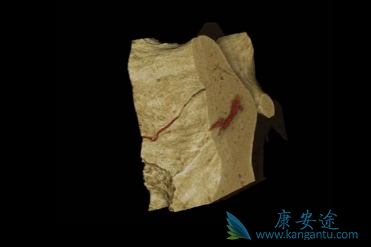 双膦酸盐 双膦酸盐