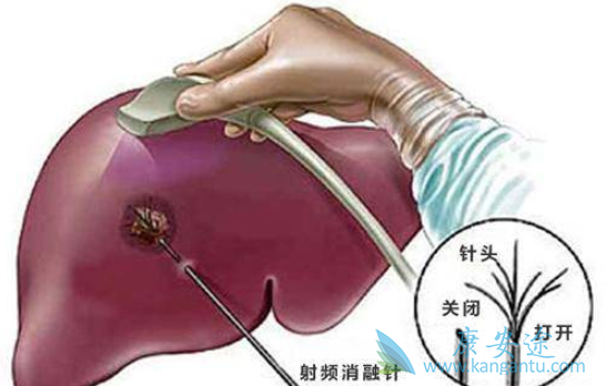 乙肝是什么病 乙肝是什么病