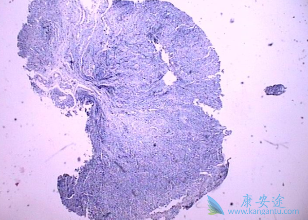低分化腺癌 低分化腺癌