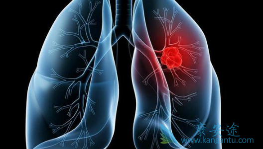 肺鳞癌 肺鳞癌
