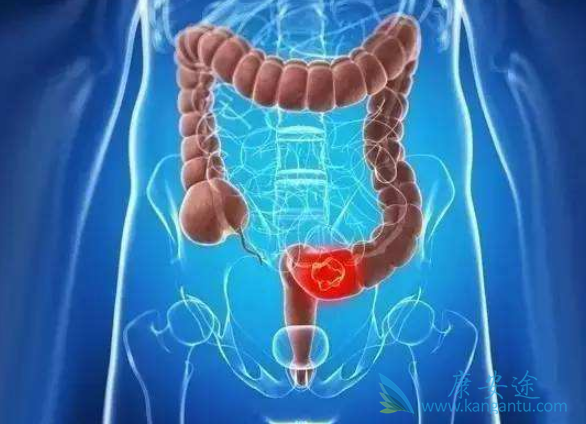 结直肠癌 结直肠癌