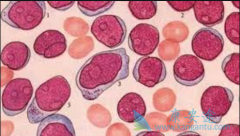 ����b�ܰ�ϸ����Ѫ����֢״����Щ��