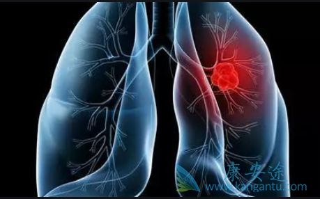 小细胞肺癌生存期 小细胞肺癌生存期