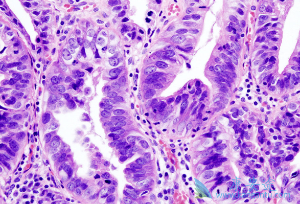 低分化腺癌化疗有效么 低分化腺癌化疗有效么