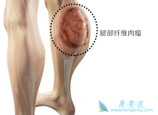 骨纤维肉瘤 骨纤维肉瘤