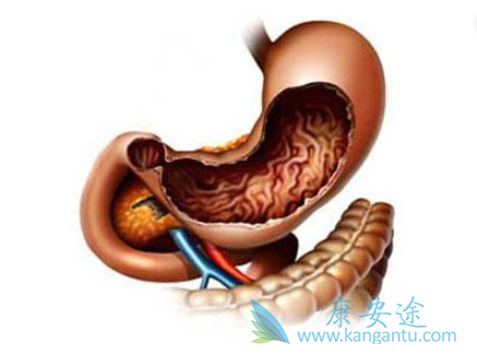 胃肠道间质瘤 胃肠道间质瘤