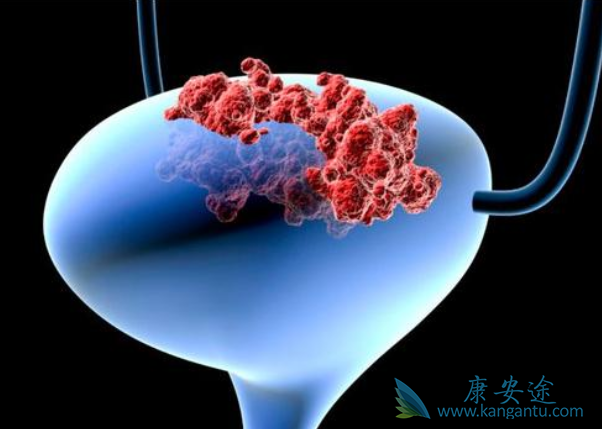 膀胱癌的早期症状 膀胱癌的早期症状