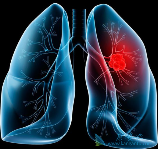 肺癌骨转移的治疗 肺癌骨转移的治疗