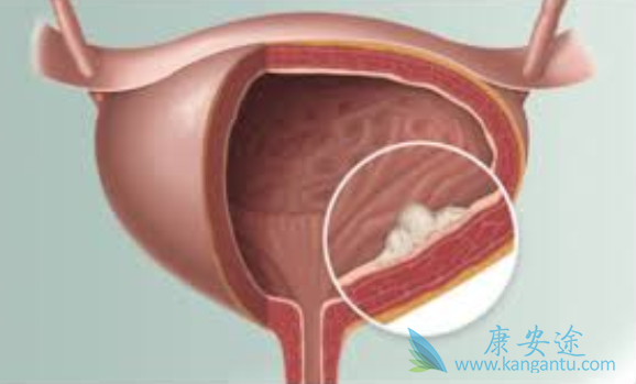 膀胱癌 膀胱癌