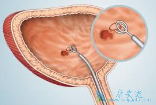膀胱癌的病因 膀胱癌的病因