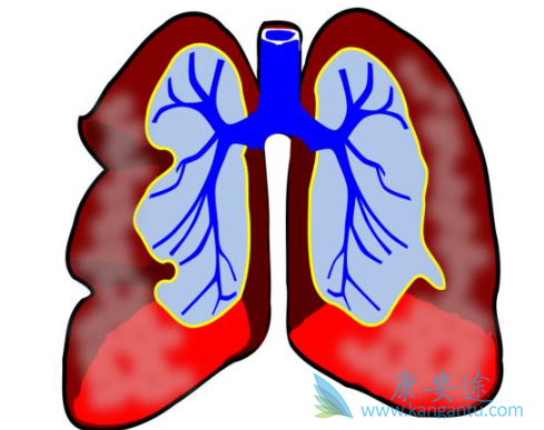 肺动脉高压治疗 肺动脉高压治疗