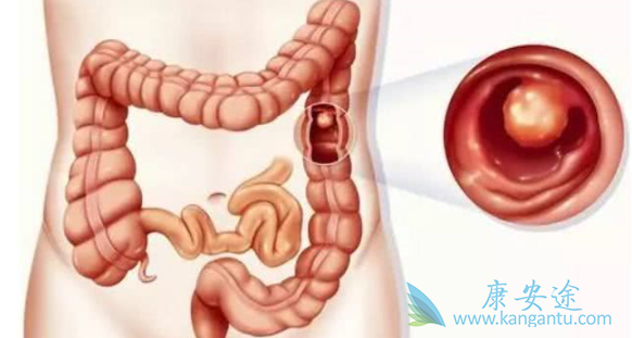 结肠癌术后能活多久 结肠癌术后能活多久