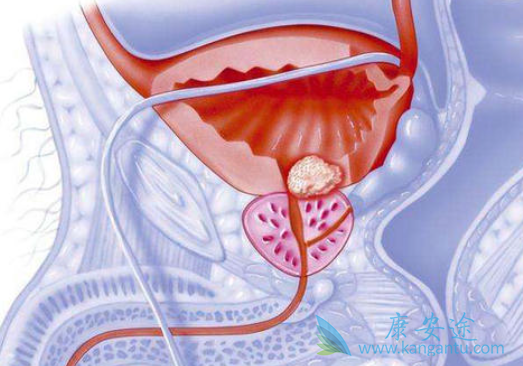 前列腺癌能活多久 前列腺癌能活多久