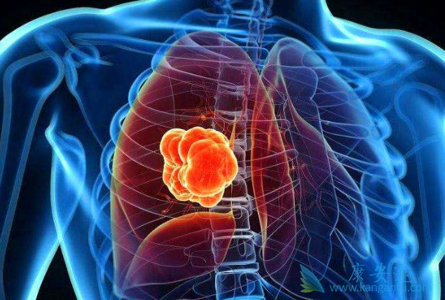 肺鳞癌 肺鳞癌