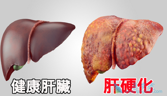 肝硬化治疗 肝硬化治疗