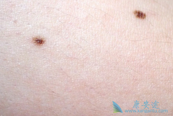 黑色素瘤治疗方法和早期症状