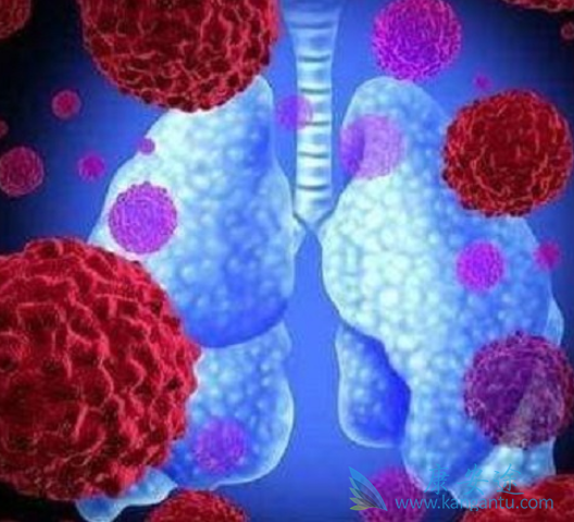 晚期肺鳞癌 晚期肺鳞癌