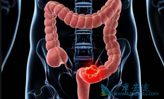 结直肠癌治疗方法 结直肠癌治疗方法