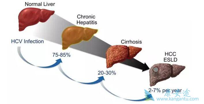 丙肝晚期症状 丙肝晚期症状
