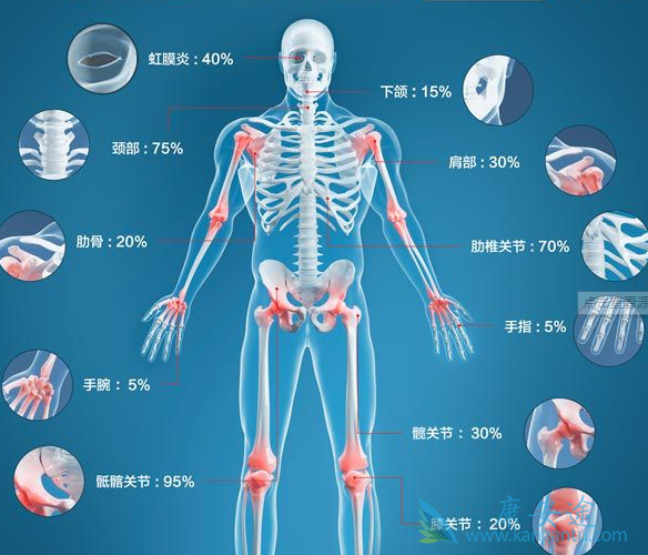强直性脊柱炎 强直性脊柱炎