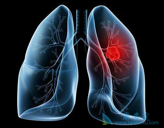 肺鳞癌 肺鳞癌