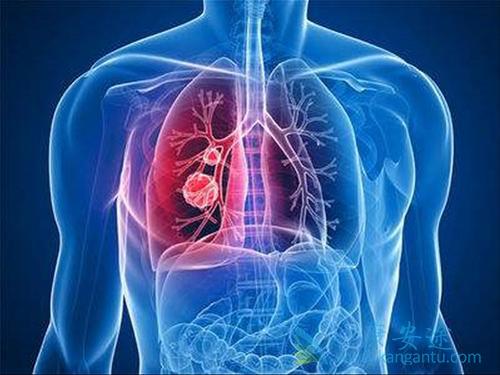 肺癌晚期 肺癌晚期