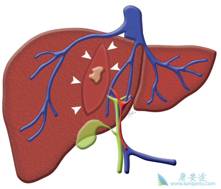 丙肝传播途径;丙肝需要治疗吗 丙肝传播途径;丙肝需要治疗吗