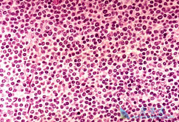 霍奇金淋巴瘤 霍奇金淋巴瘤