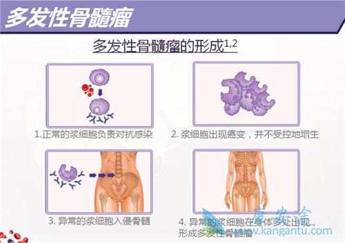 多发性骨髓瘤 多发性骨髓瘤