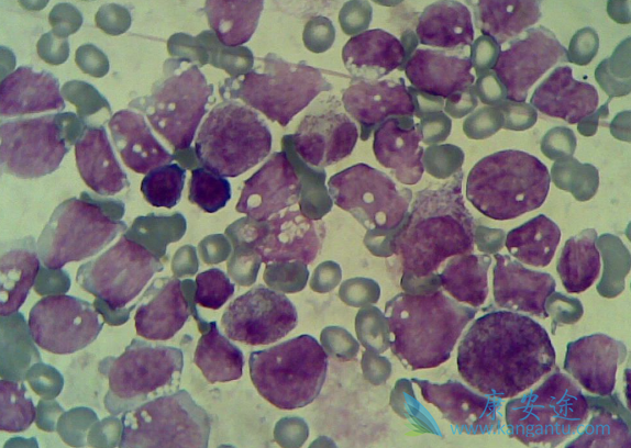 白血病治疗 白血病治疗