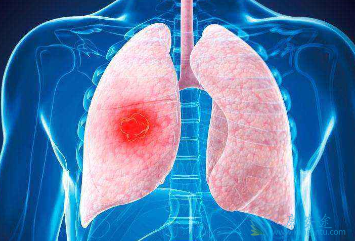 肺癌治疗;靶向治疗 肺癌治疗;靶向治疗