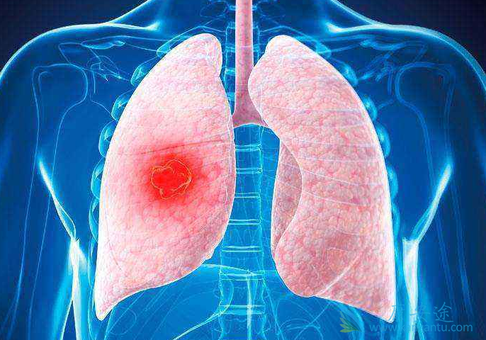 肺癌治疗;肺癌病人吃什么 肺癌治疗;肺癌病人吃什么