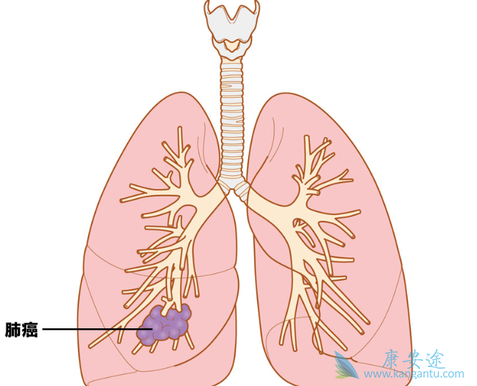 癌症晚期能活多久;肺癌病人吃什么 癌症晚期能活多久;肺癌病人吃什么