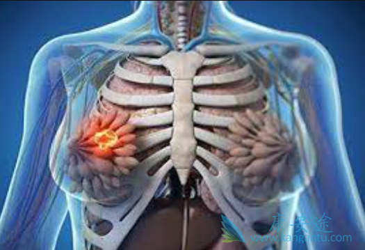 晚期乳腺癌 晚期乳腺癌