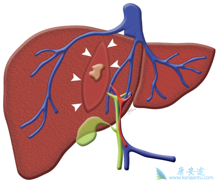 丙肝治疗;吉三代 丙肝治疗;吉三代