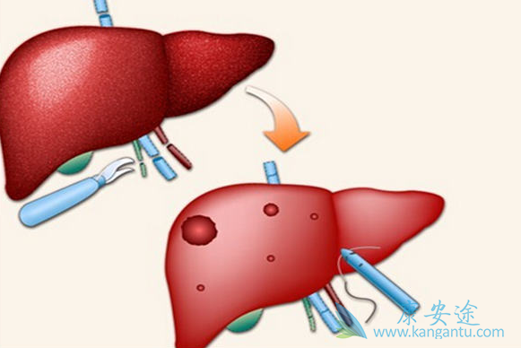 丙肝;丙肝抗体 丙肝;丙肝抗体