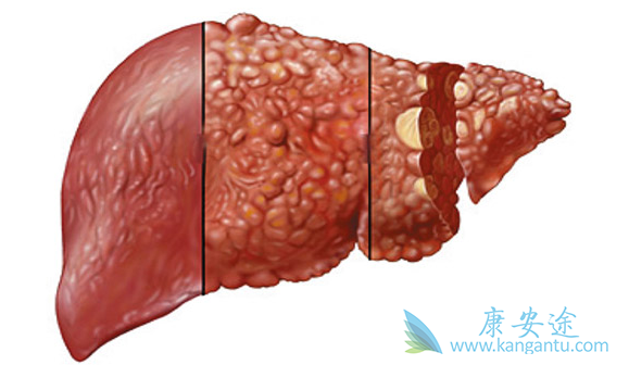 肝癌患者在临床上有哪些症状?恶性肿瘤全身性表现在哪?
