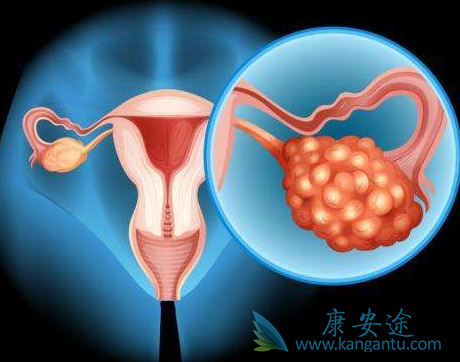 卵巢癌;治疗卵巢癌 卵巢癌;治疗卵巢癌