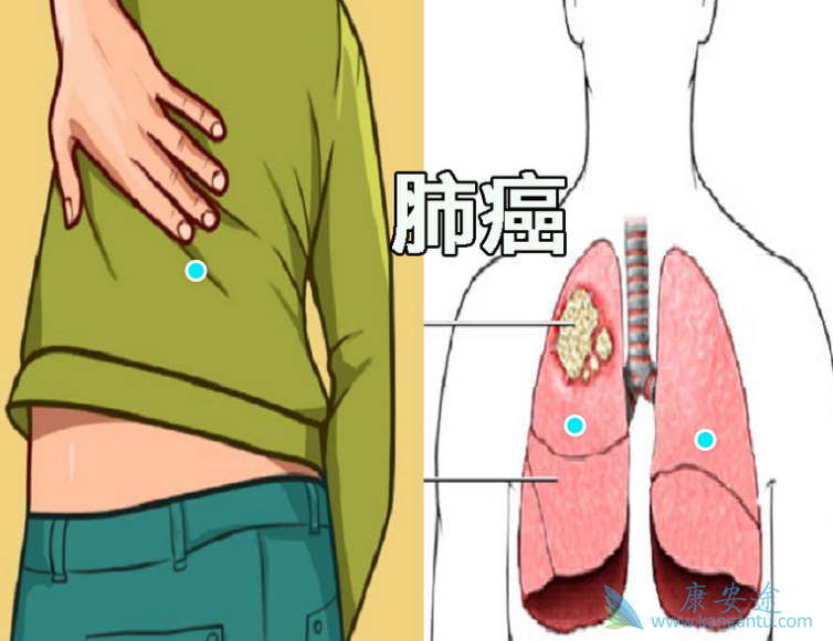 需要进行肺癌的治疗吗?