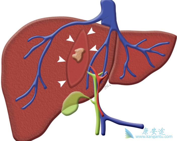 丙肝病毒 丙肝病毒